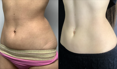 Tummy Body Contouring Fat Reduction Before After Mississauga Oakville